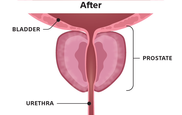 Illustration of a bladder after catherization.