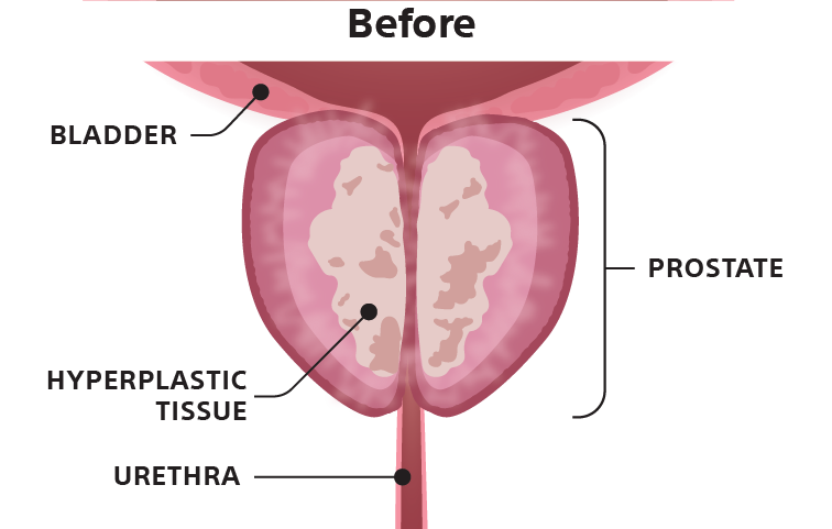 Illustration of a bladder before catherization.