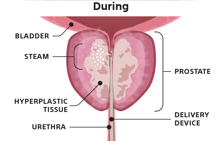 Illustration of a bladder during catherization.