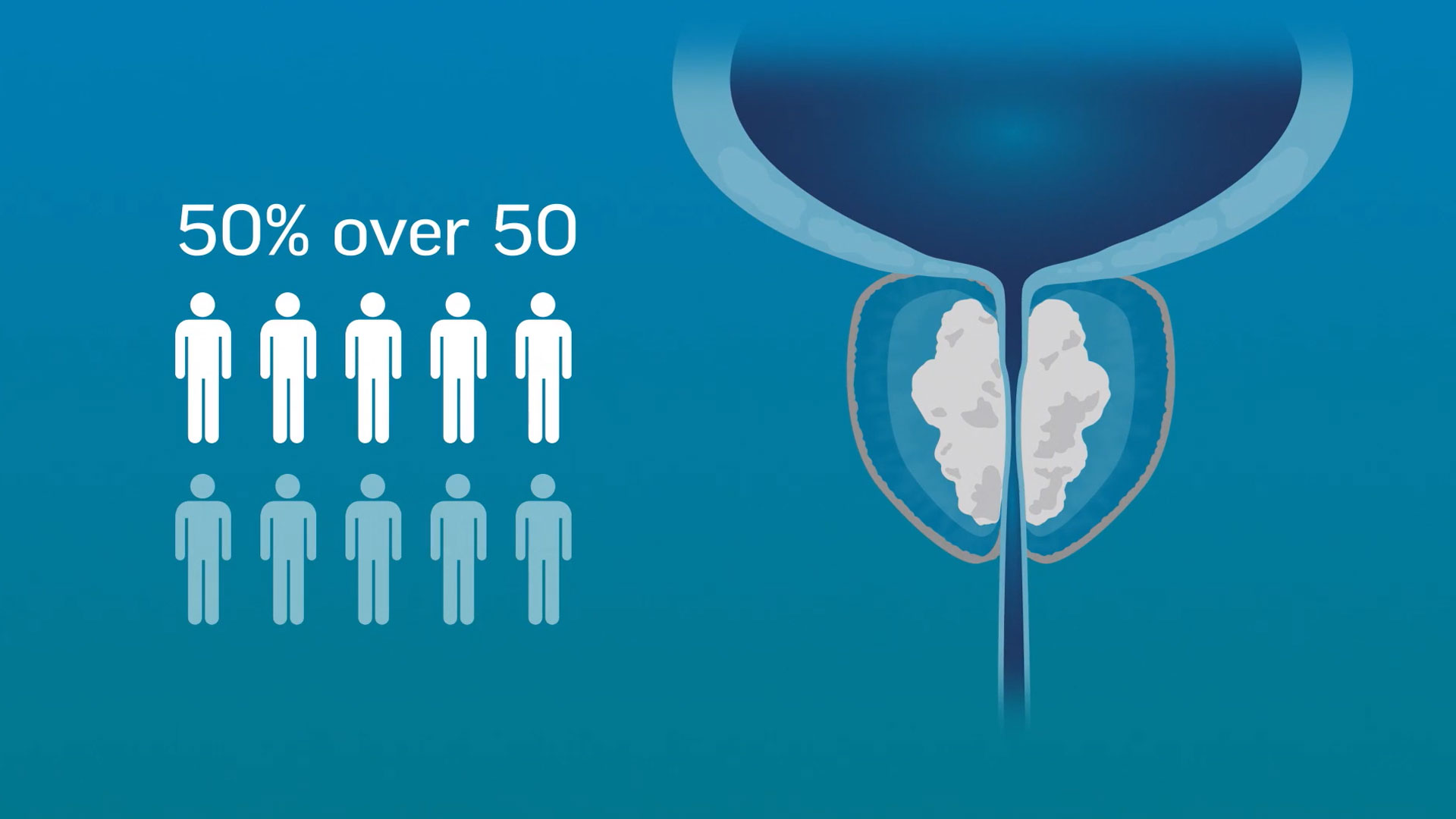 Rezūm Water Vapor Therapy